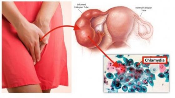 nhiem-khuan-chlamydia-avatar_760x367.jpg